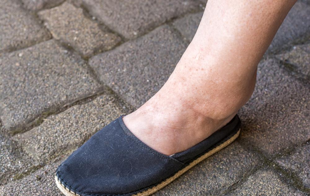 9 Causes of Ankle Swelling