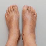 Is Your Swollen Ankle a Sign of a Blood Clot