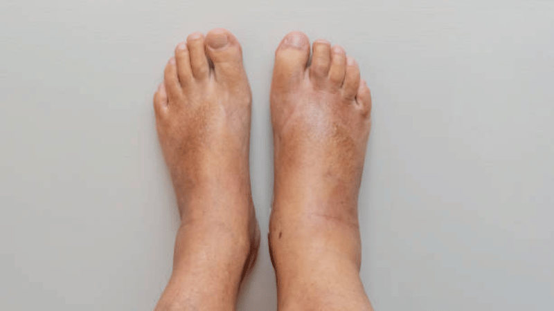 Is Your Swollen Ankle a Sign of a Blood Clot