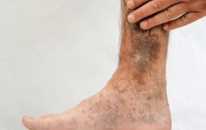 Stasis Dermatitis