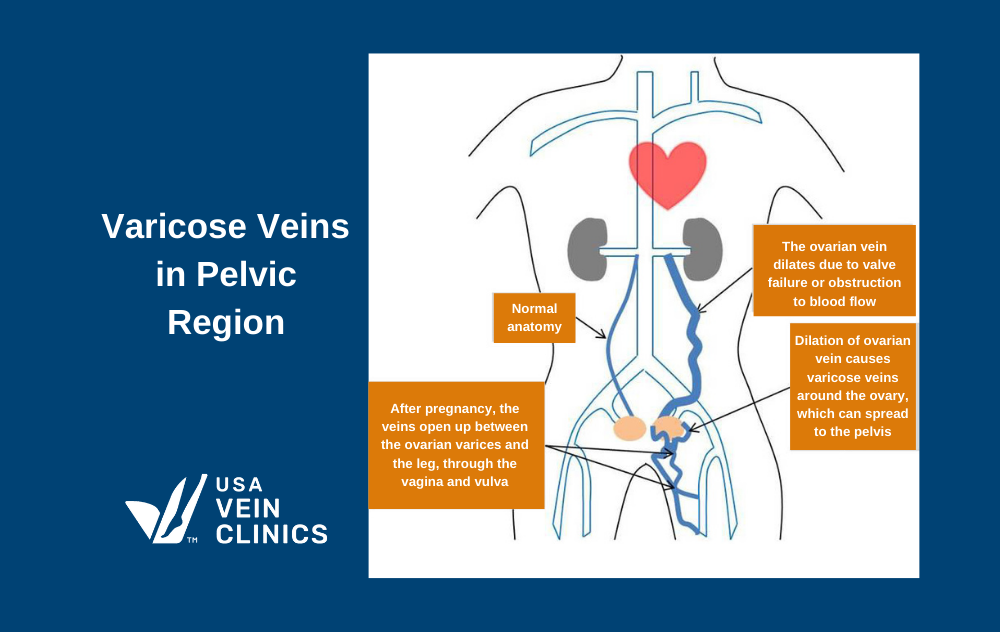 Varicose veins in the pelvic region