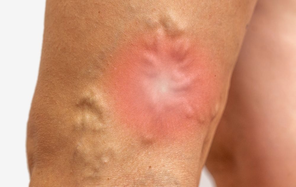 Varicose Veins Burning