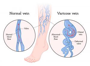 Cause of Vein Disease