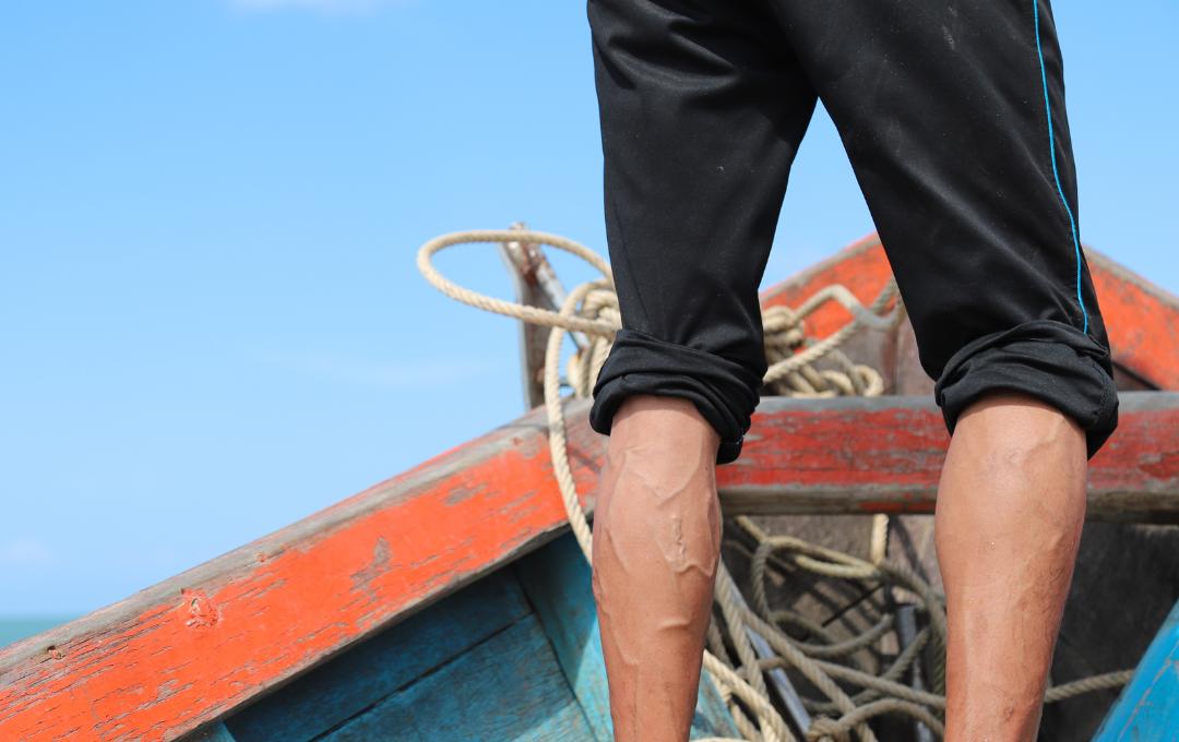 is the sun good for varicose veins