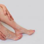 why do varicose veins occur in the legs