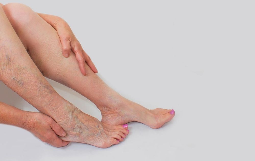 why do varicose veins occur in the legs