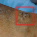 What causes varicose veins to rupture or burst? How can you prevent varicose veins from bursting and what to do if they do rupture?
