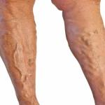 Bulging Varicose veins on legs cause anxiety