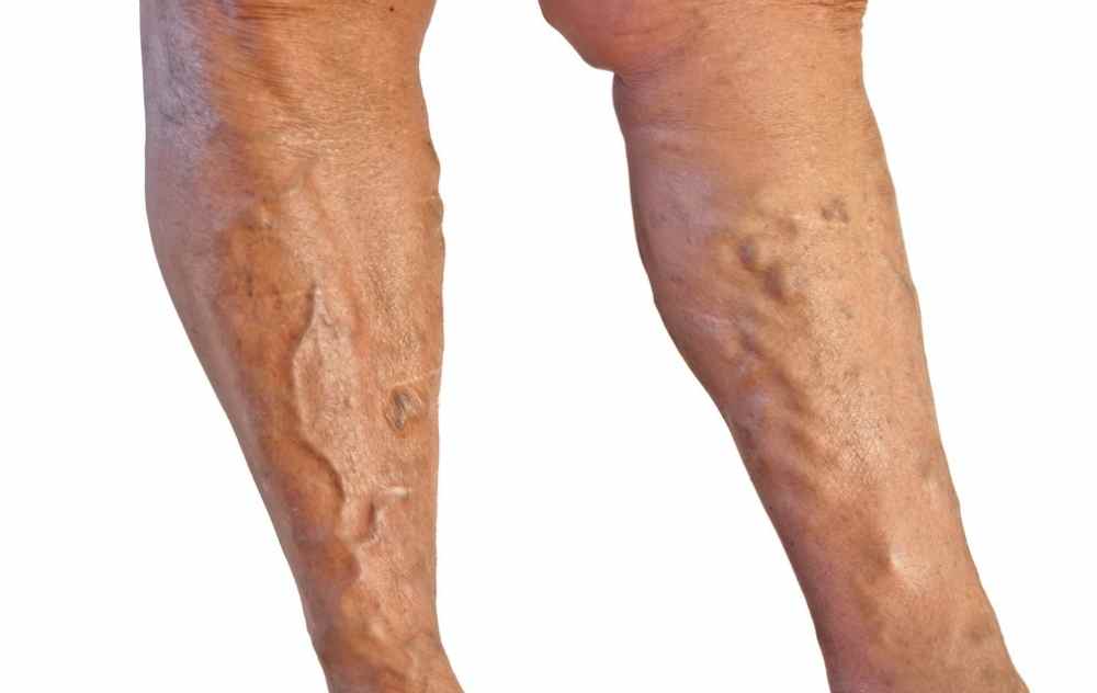 Bulging Varicose veins on legs cause anxiety