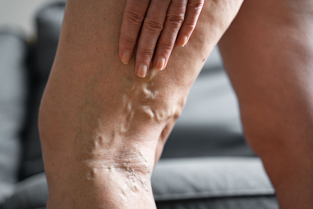 what causes varicose veins