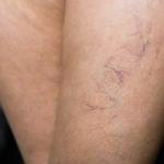 visible veins