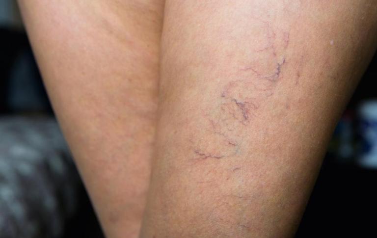 why-are-my-veins-so-visible-usa-vein-clinics