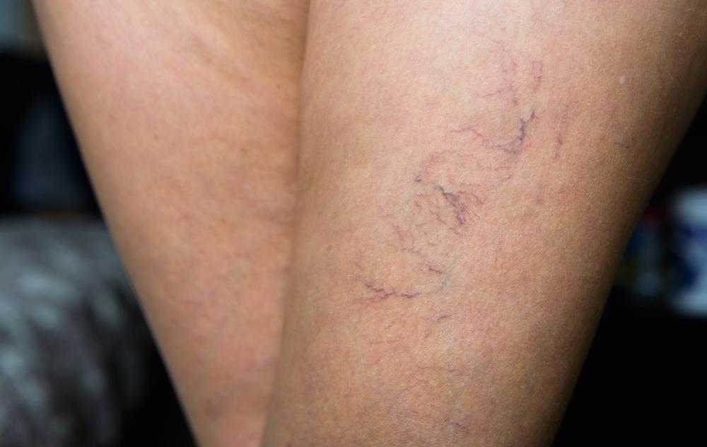 linse tøj nedbryder Why Are My Veins So Visible? - USA Vein Clinics