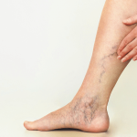 Why Your Veins Are So Visible