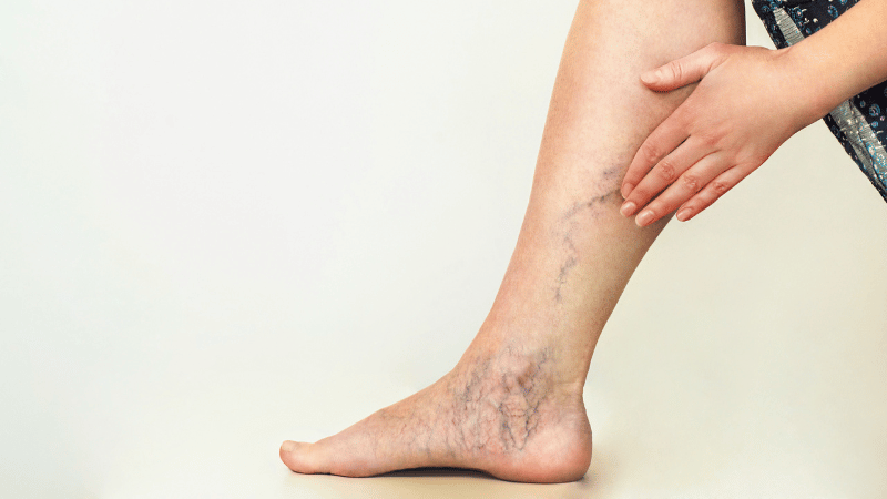 Why Your Veins Are So Visible