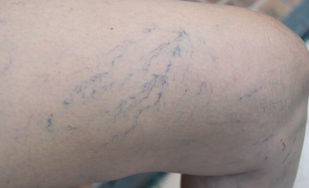 thigh with blue veins