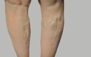 Unhealthy diet leads to varicose veins