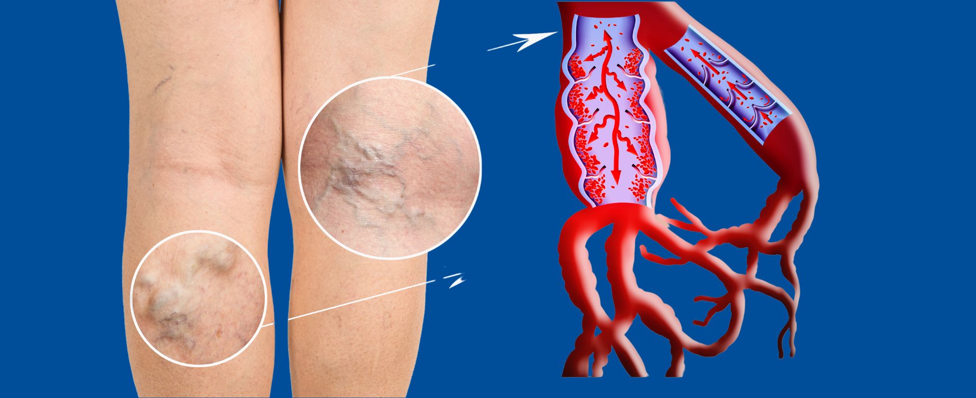 Can Varicose Veins Go Away? USA Vein Clinics