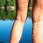 Varicose Veins Go Away On Own