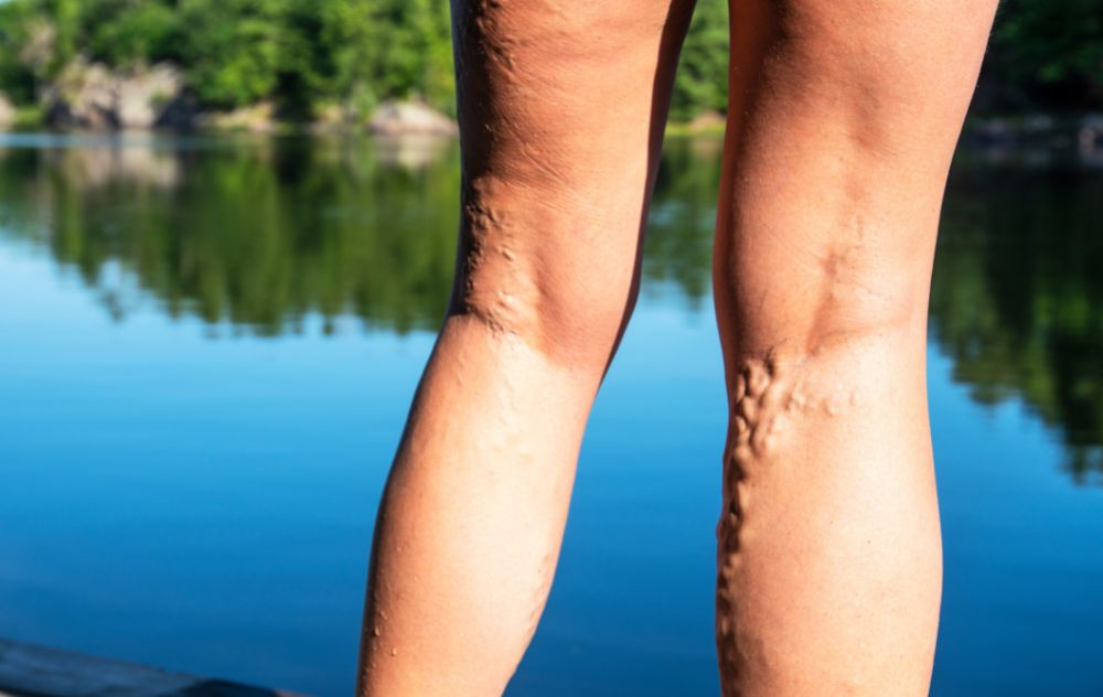 Varicose Veins Go Away On Own