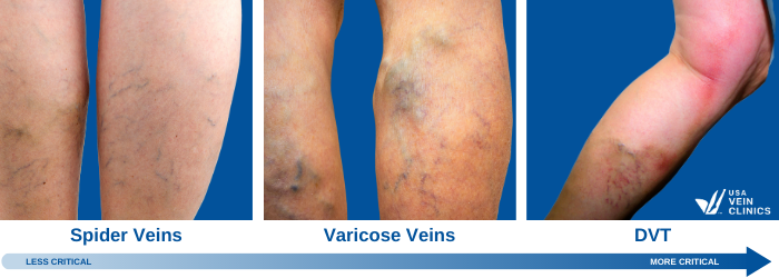 Vein disease comparison