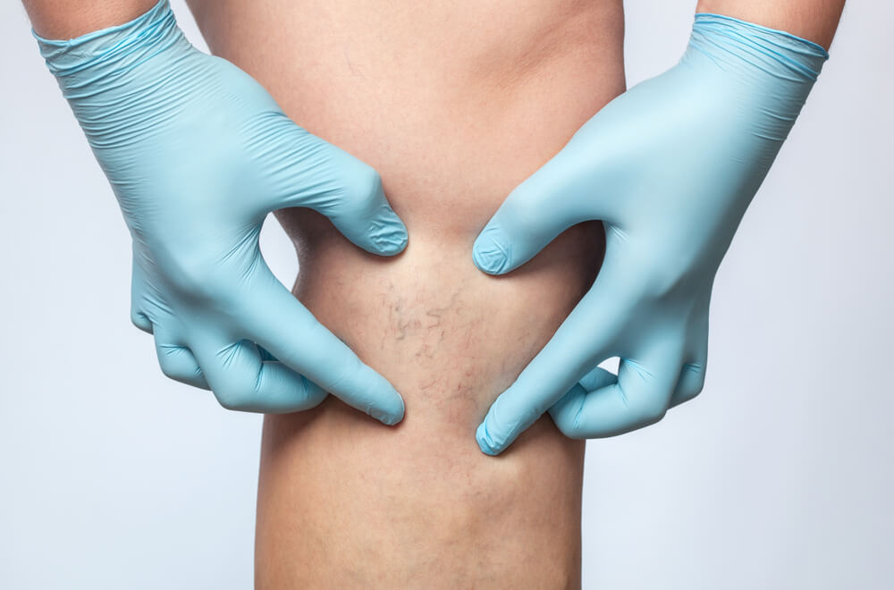 frequently asked questions on vein disease