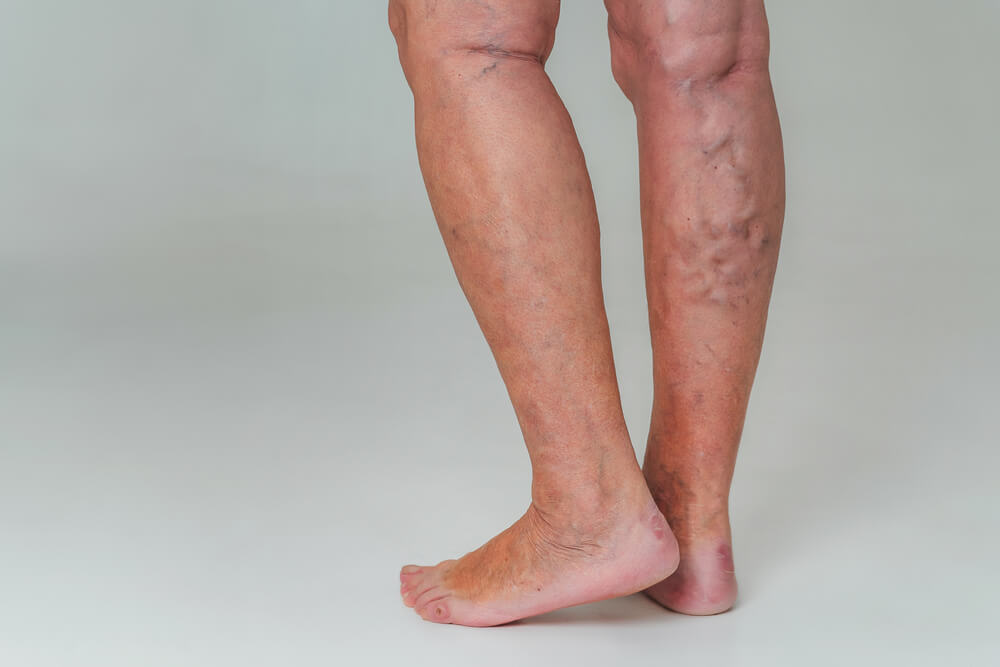 Vein Disease on Legs