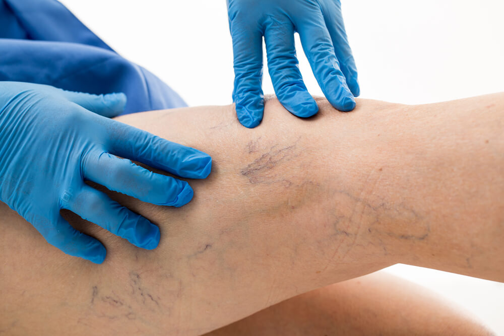 Vein Doctor answers Spider vein questions
