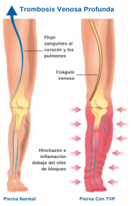 Síntomas de Trombosis Venosa Profunda