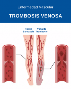 Trombosis venosa profunda frente a venas normales