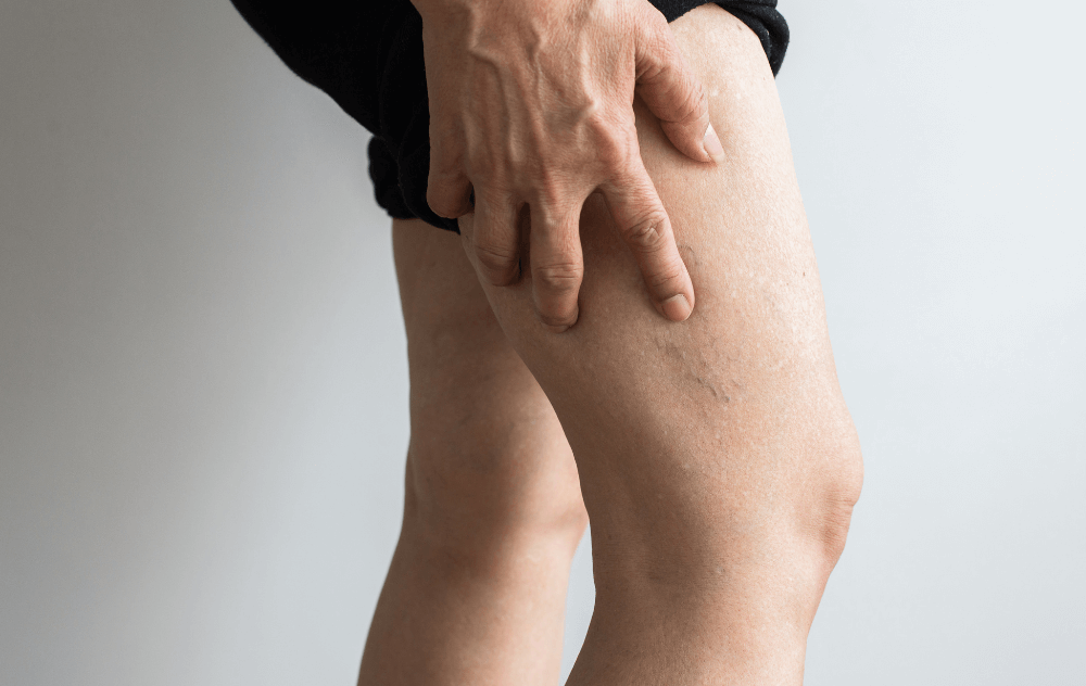 Sclerotherapy Treatment for Spider Veins