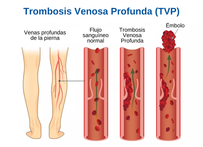 palo alarma arco Síntomas y tratamiento de la trombosis venosa profunda | USA Vein Clinics