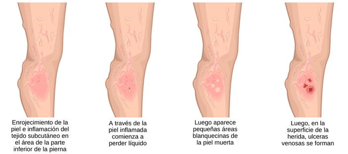 avaro pulgada Incorporar Síntomas de úlceras venosas, tratamiento y etapas de las úlceras venosas de la  pierna