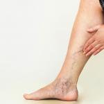 Vein Disease on the Legs