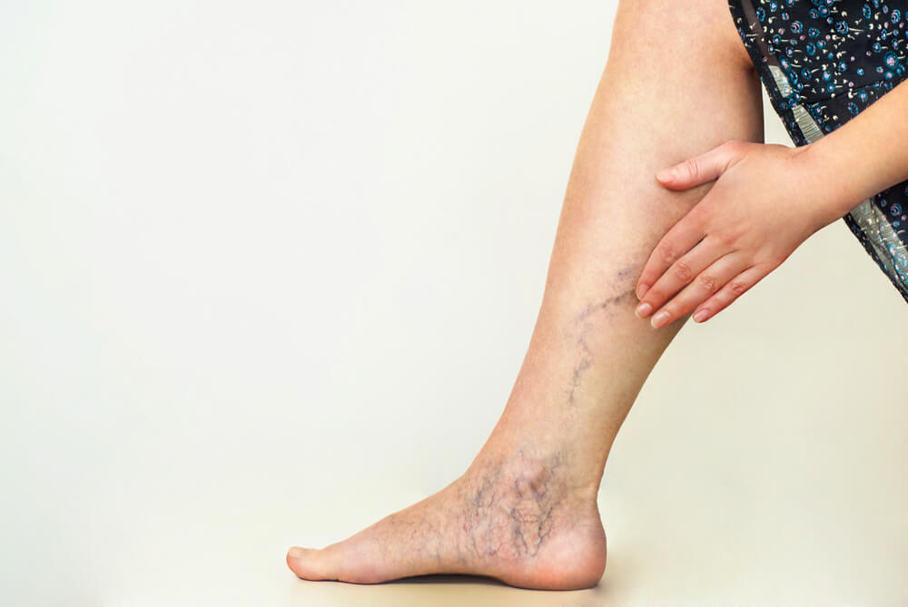Vein Disease on the Legs