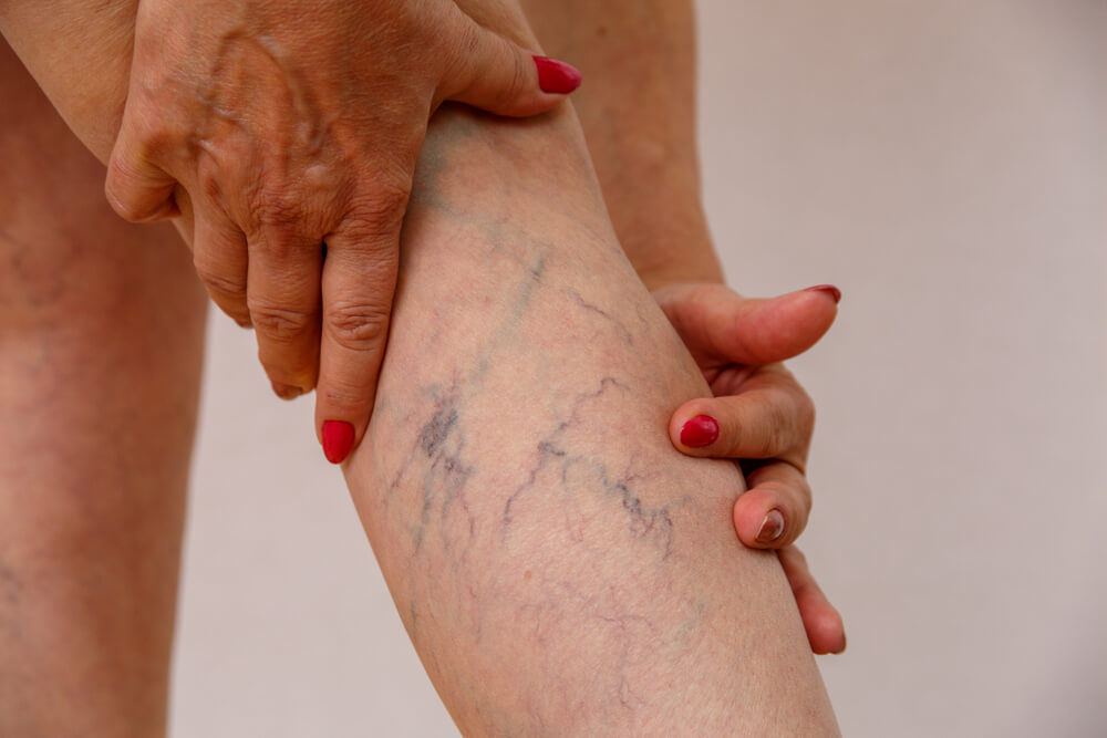 Varicose Veins on Legs