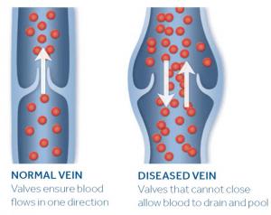 Normal vs Diseased Veins
