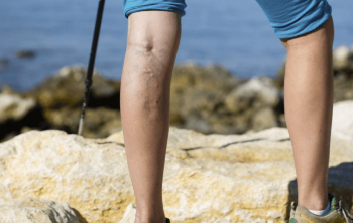 Person with Varicose Veins in the Legs Standing Outside