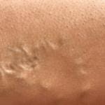 What Are Varicosities? 10 Varicosities