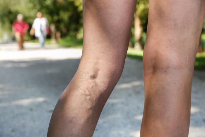 Person Standing With Varicose Veins