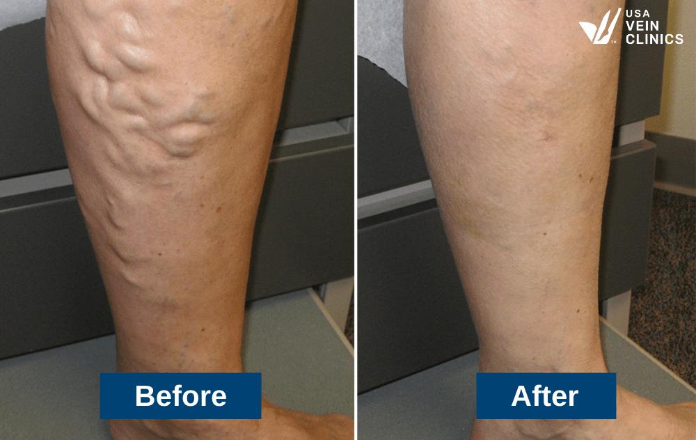 Varicose Vein Treatment 6 Varicose Vein Treatment Before and After