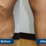 Varicose Vein Treatment Before and After