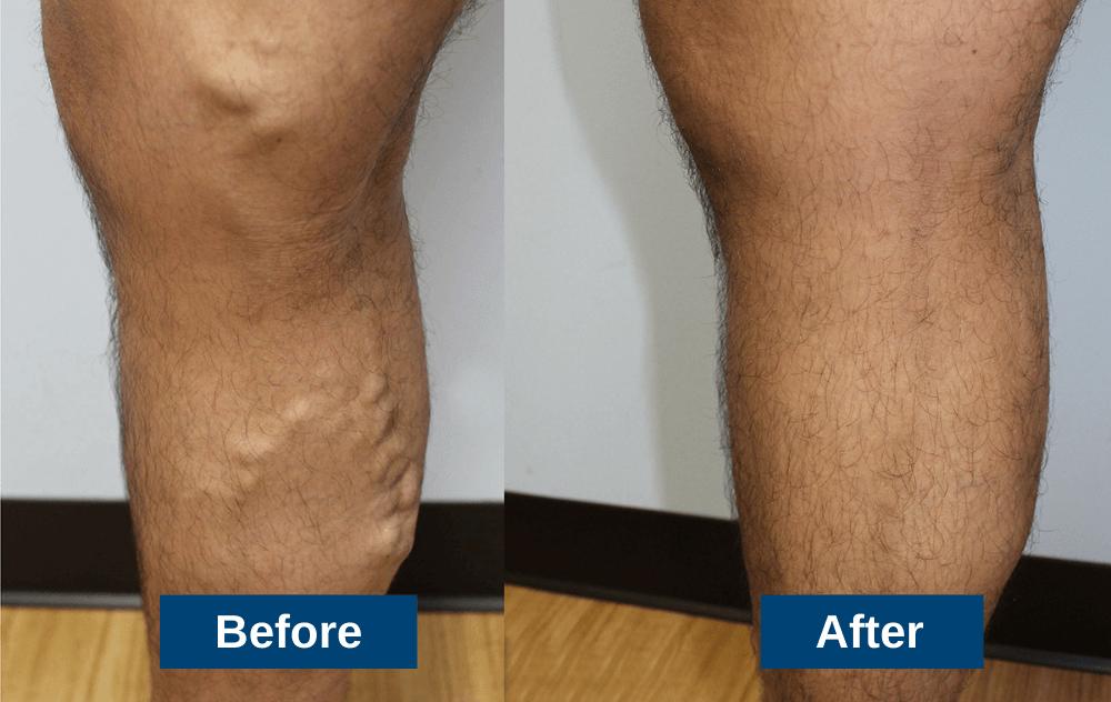 Varicose Vein Treatment Before and After