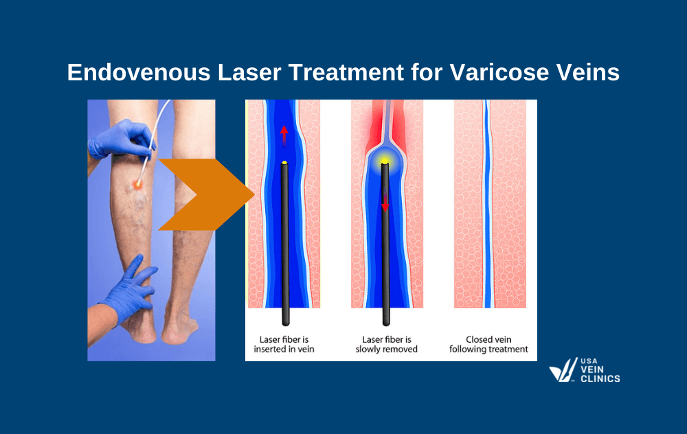 Endovenous Laser Treatment (EVLT)