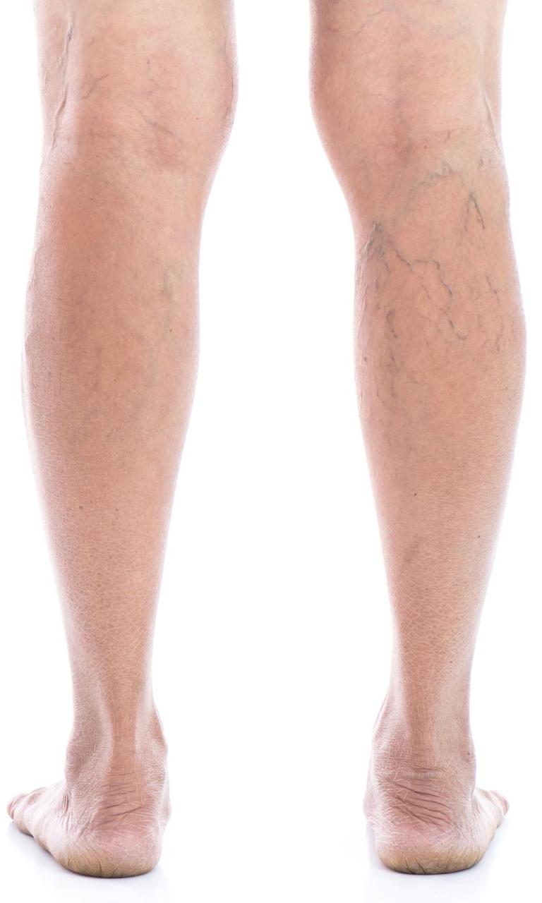 How Do You Fix Poor Circulation? USA Vein Clinics