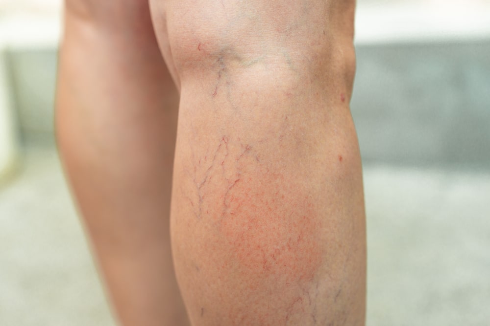 What Causes Varicose Veins