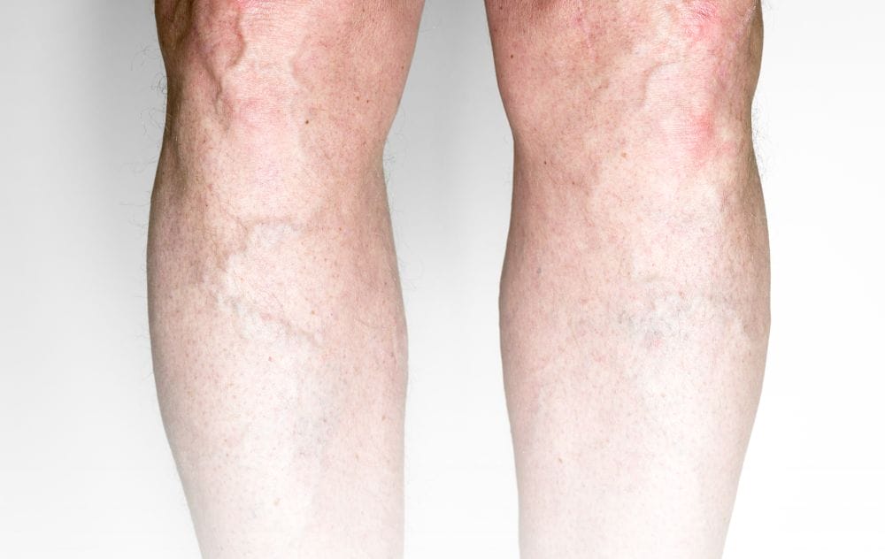 Are Varicose Veins Dangerous? 19 Looking at varicose veins and wondering if they are dangerous