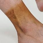 What Is Post Thrombotic Syndrome? 10 Post-Thrombotic Syndrome (PTS)