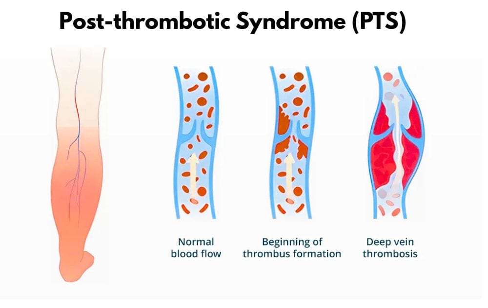 What Is Post Thrombotic Syndrome? 5 post-thrombotic syndrome (pts) illustration