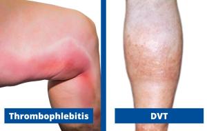 Thrombophlebitis vs DVT